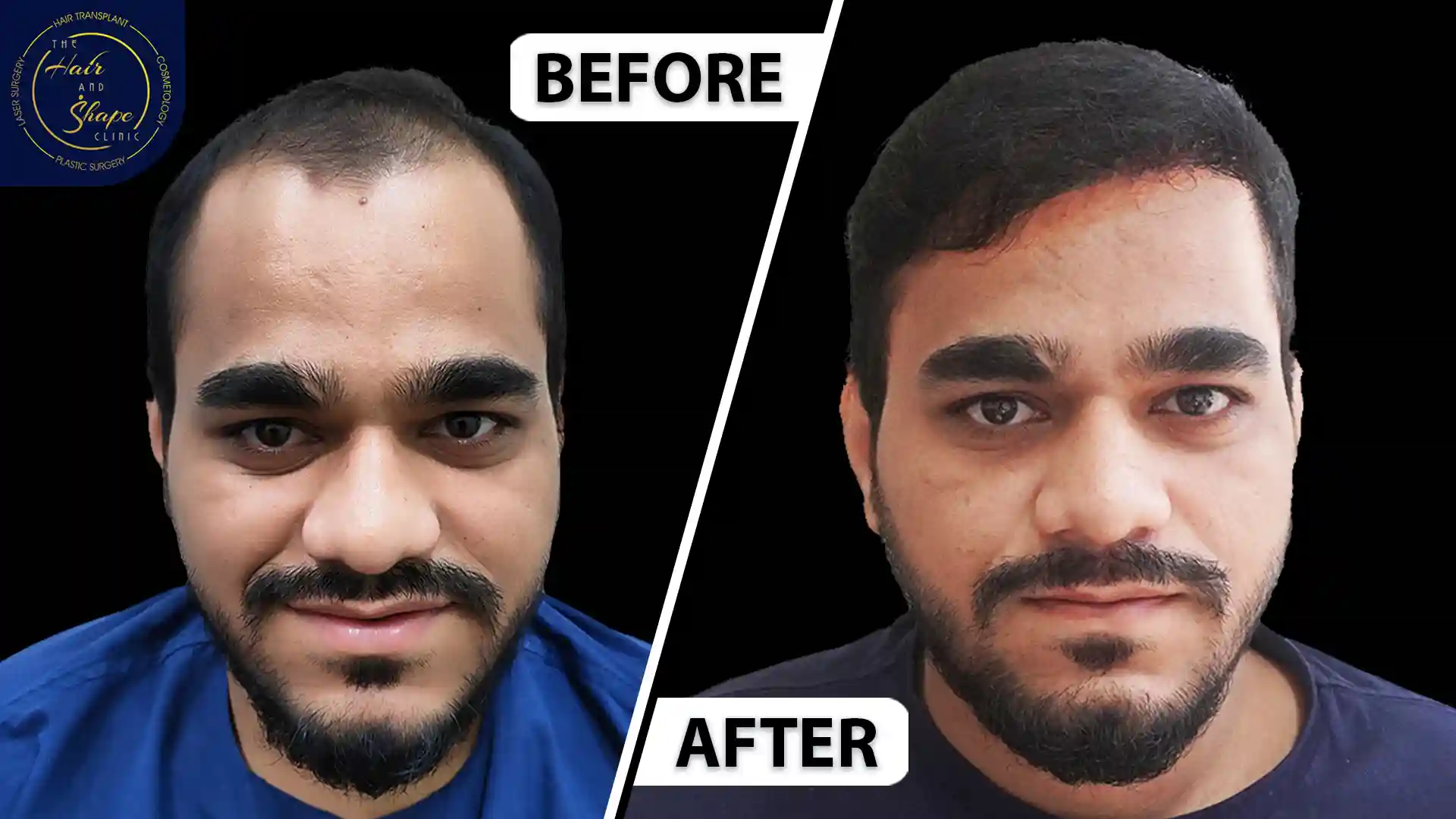 Hair Transplant result4